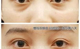 眼袋修复公益救助——冰洁克莱美舍